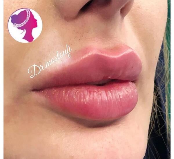 عکس ژل لب عروسکی