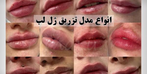 عکس ژل لب عروسکی