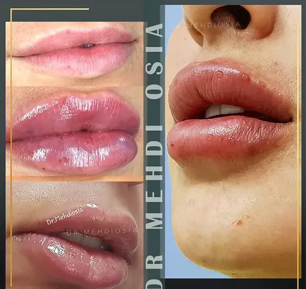 عکس ژل لب عروسکی