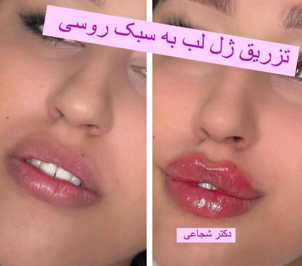 عکس ژل لب کره ای