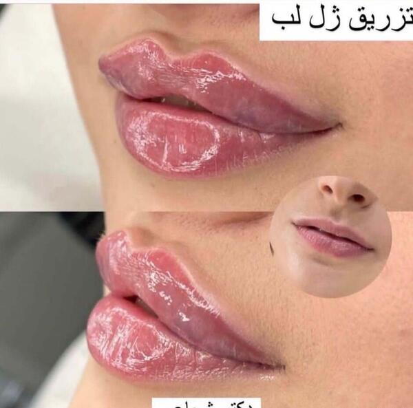 عکس ژل لب کره ای