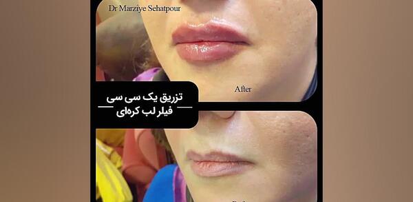 عکس ژل لب کره ای
