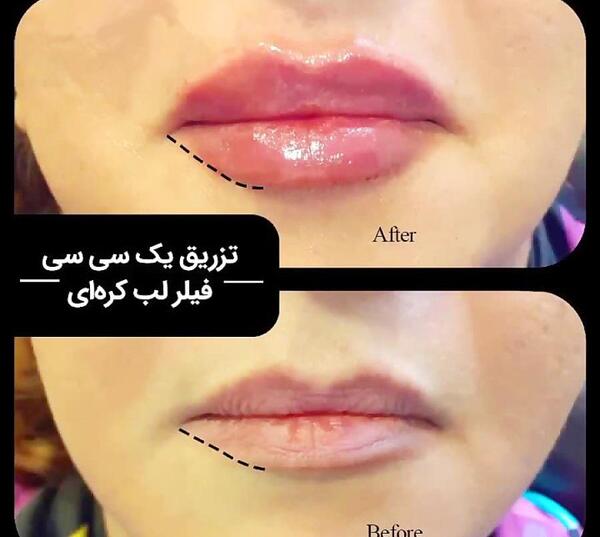 عکس ژل لب کره ای