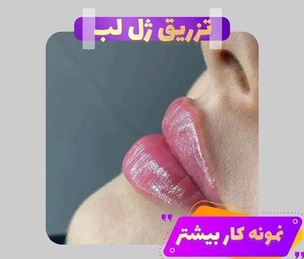 عکس ژل لب کره ای