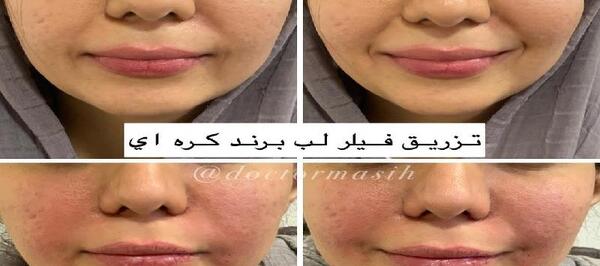 عکس مدل لب کره ای