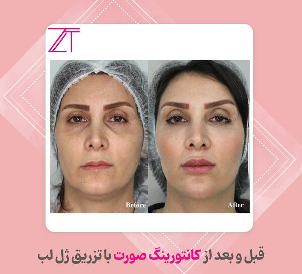 عکس کوچکترین لب دنیا