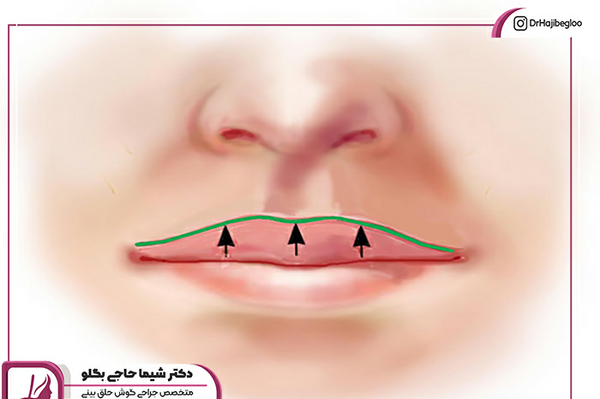 عکس لیفت لب با نخ