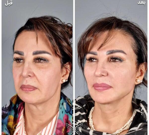 عکس لیفت لب با نخ