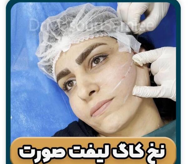 عکس لیفت لب با نخ