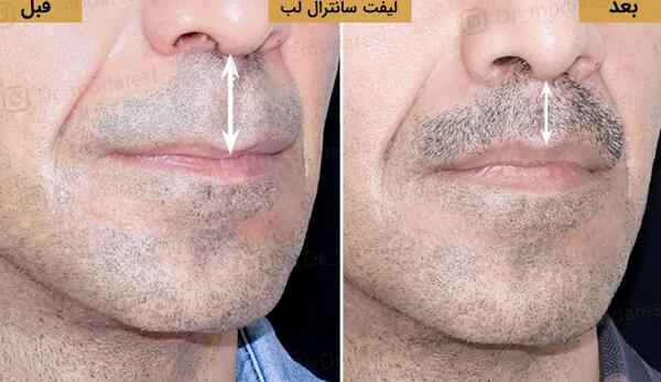 عکس لیفت لب با نخ