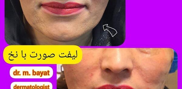 عکس لیفت لب با نخ