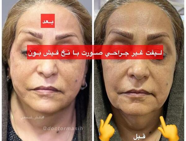 عکس لیفت لب با نخ