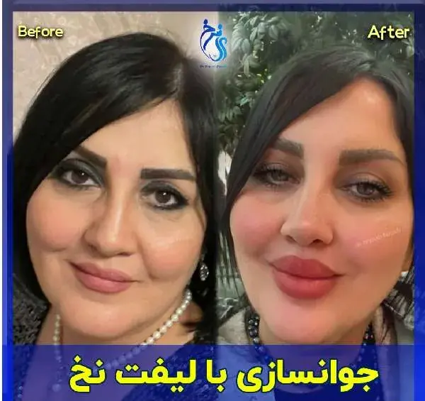 عکس لیفت لب با نخ