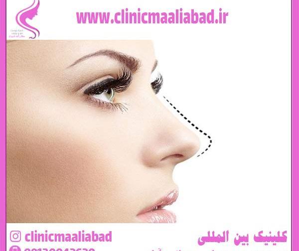 عکس لیفت لب با نخ