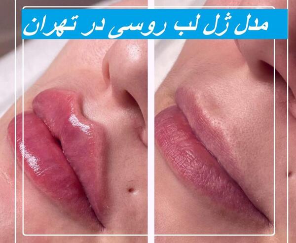 عکس لیفت لب روسی