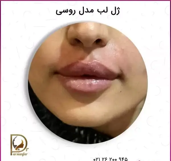 عکس لیفت لب روسی
