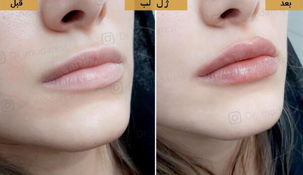 عکس لیفت لب روسی
