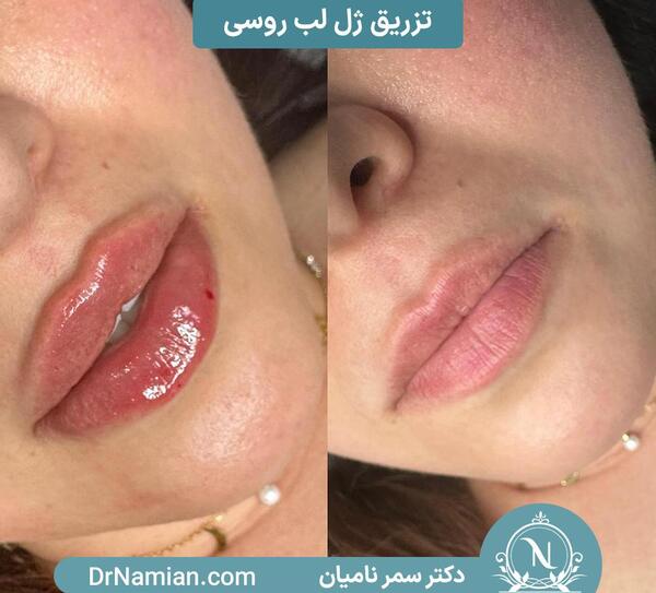 عکس لیفت لب روسی