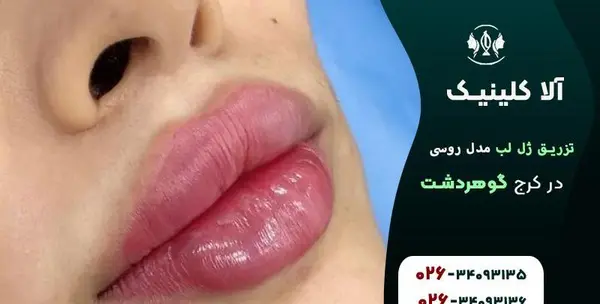 عکس لیفت لب روسی