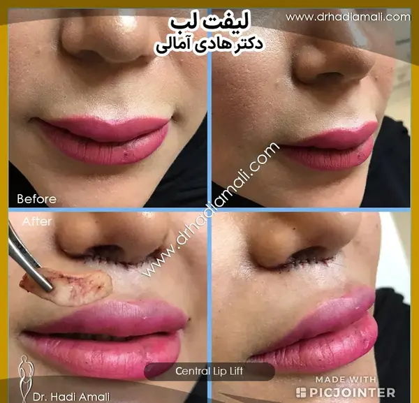 عکس لیفت لب بالا