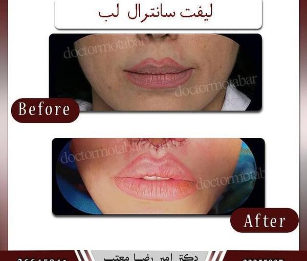 عکس لیفت لب بالا