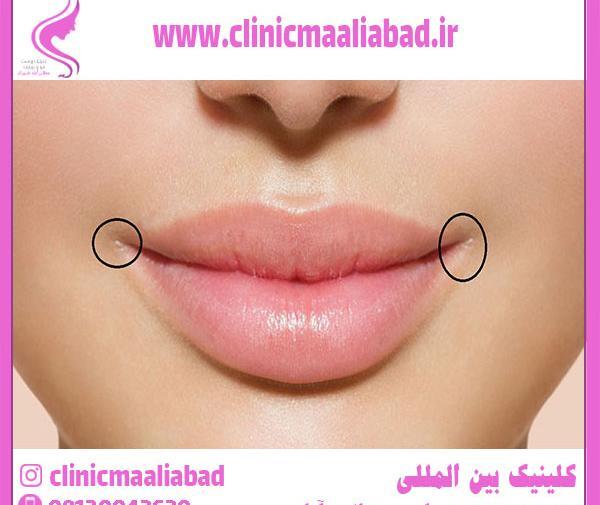 عکس لیفت لب بالا