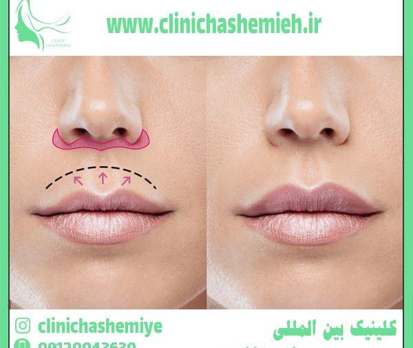 عکس لیفت لب بالا