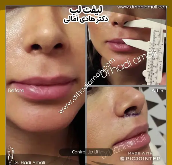 عکس لیفت لب بالا