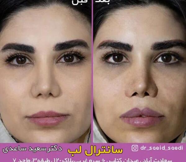 عکس لیفت لب بالا