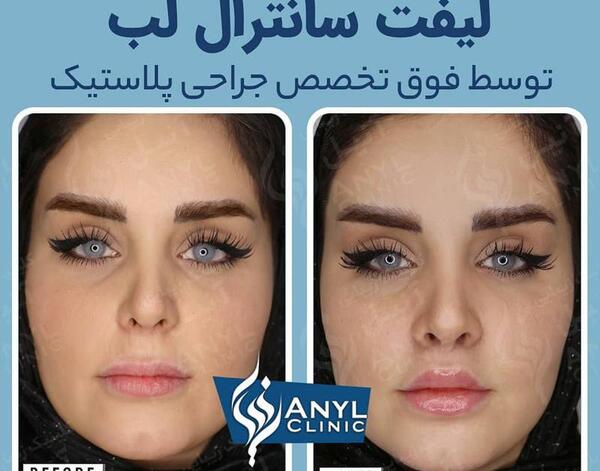 عکس لیفت لب بالا
