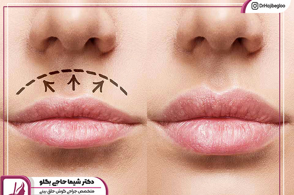 عکس لیفت لب بالا