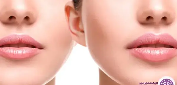 عکس لیفت لب بالا