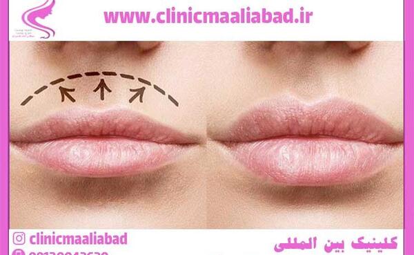 عکس لب لیفت شده