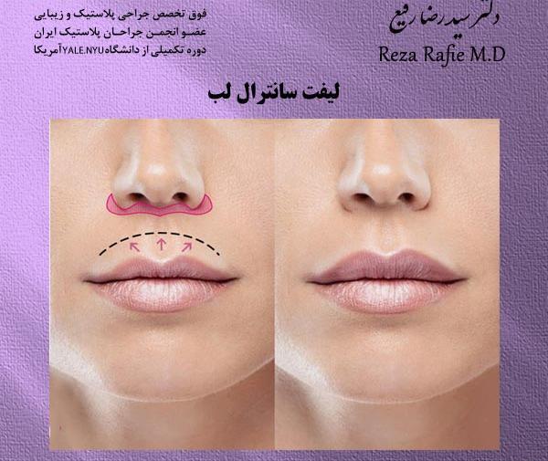 عکس لب لیفت شده