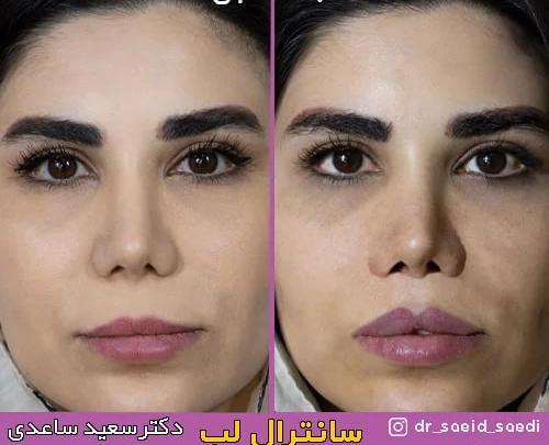 عکس لب لیفت شده