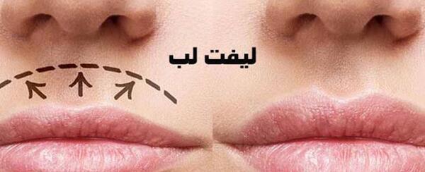 عکس لب لیفت شده