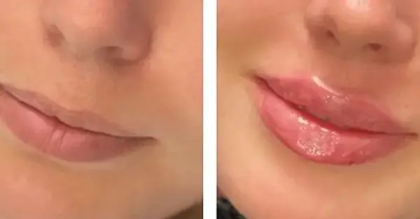 عکس فیلر لب مدل روسی