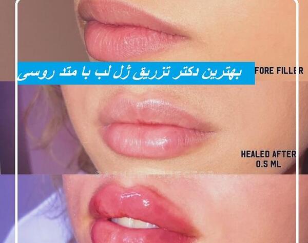 عکس فیلر لب مدل روسی