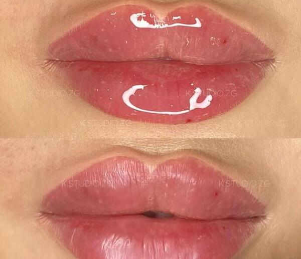 عکس فیلر لب مدل روسی