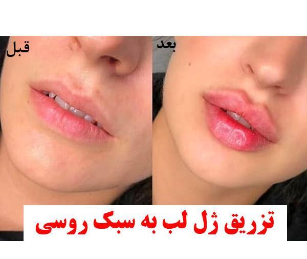 عکس فیلر لب مدل روسی