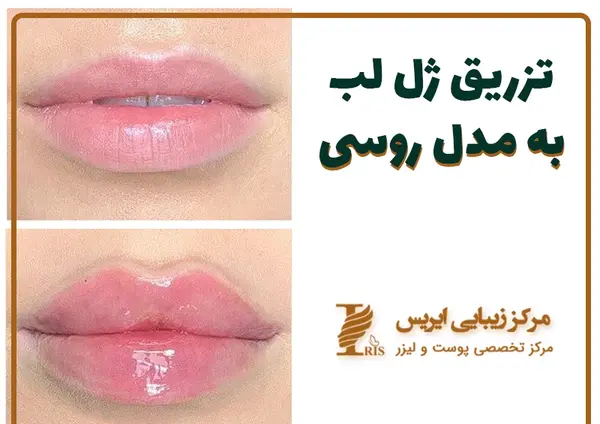 عکس فیلر لب مدل روسی