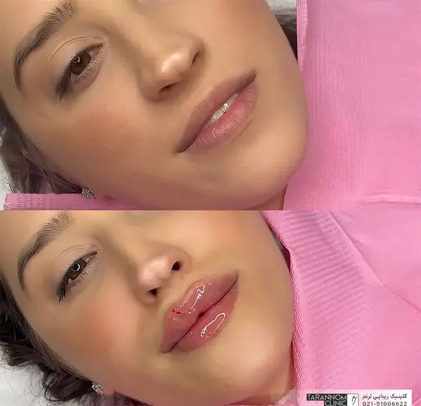 عکس فیلر لب مدل روسی