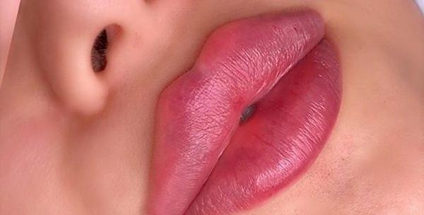 عکس پروتز لب مدل روسی