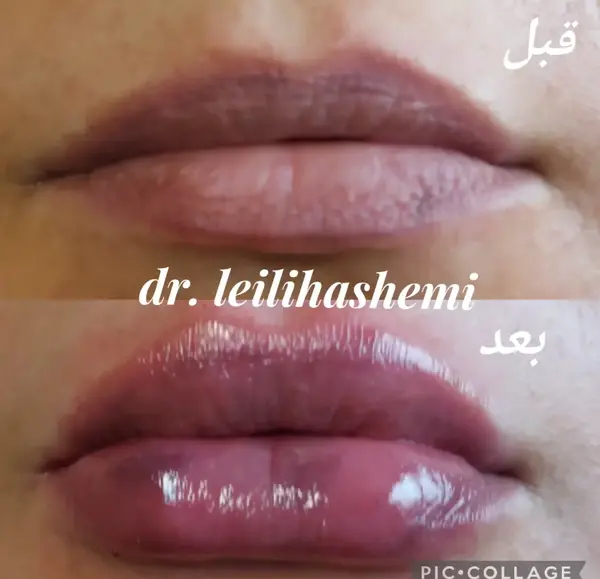 عکس پروتز لب مدل روسی