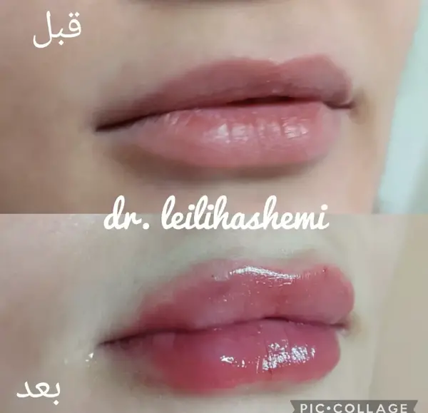 عکس پروتز لب مدل روسی