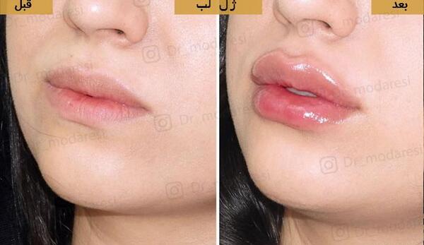 عکس پروتز لب مدل روسی