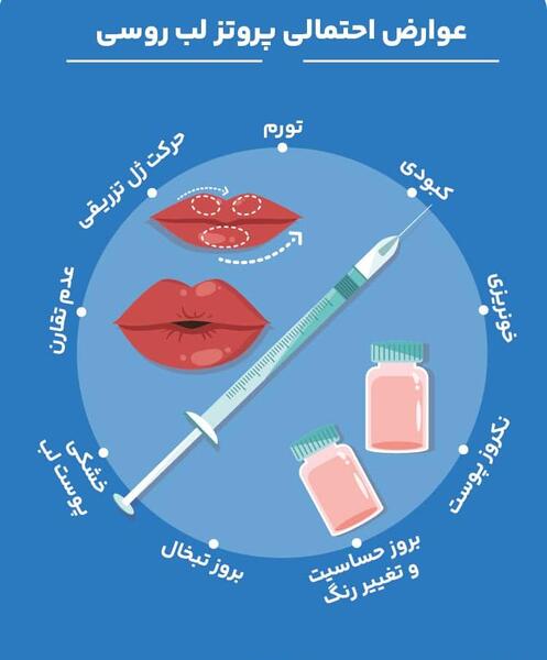 عکس پروتز لب مدل روسی