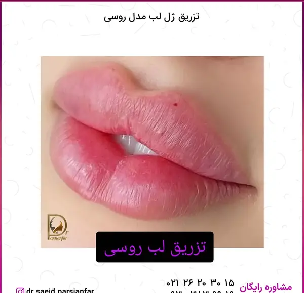 عکس پروتز لب مدل روسی