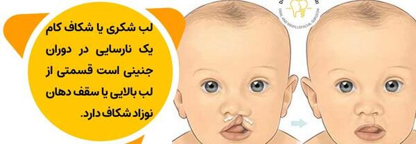 عکس بچه ی لب شکری