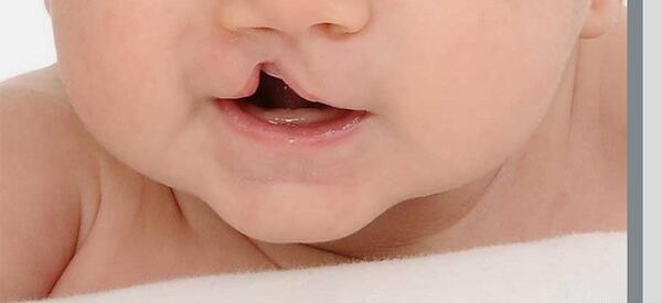 عکس بچه ی لب شکری